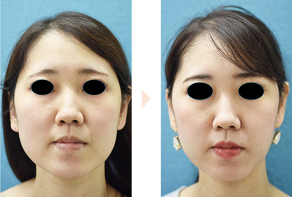 ジョールファット除去(下膨れ顔の改善・小顔治療)の症例写真・ビフォーアフター