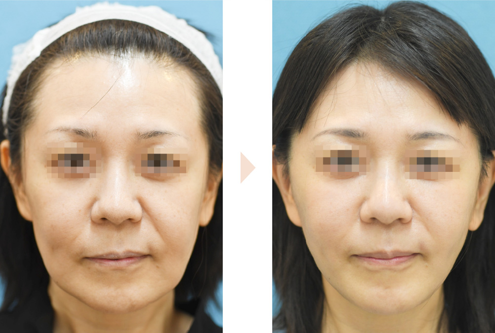 ジョールファット除去+糸リフト(中顔面~下顔面のたるみ取り)の症例写真・ビフォーアフター