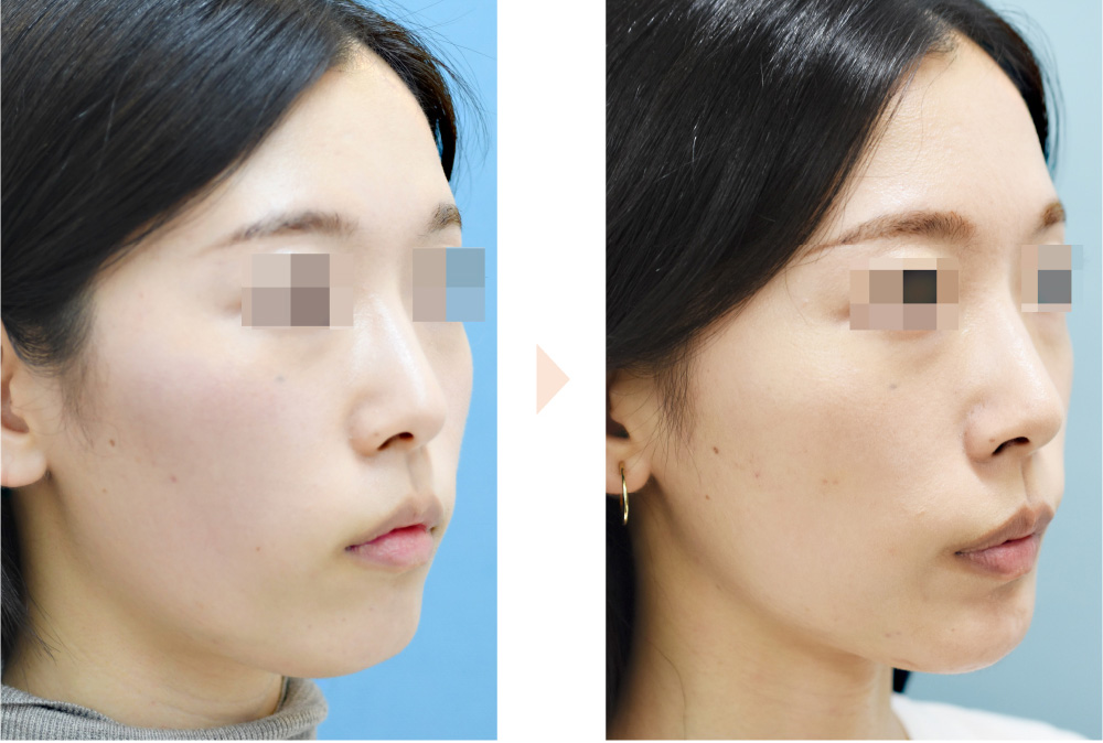 Vライン形成(小顔整形+左右差改善)の症例写真・ビフォーアフター