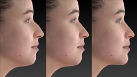 術前に精密な術後3D画像で仕上がりを確認できます